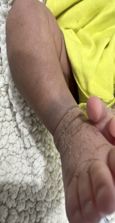 Patient 1: dark blue mark on the tibiotarsal joint