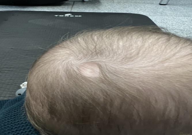 Patient 10: scalp lesion, aplasia cutis
