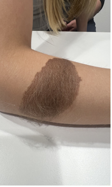 Patient 2: hyperpigmented patch on the right forearm