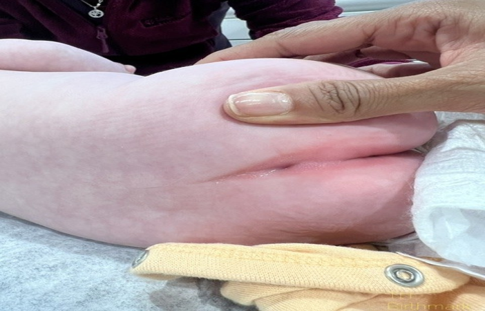 Patient 8: sacral dimple