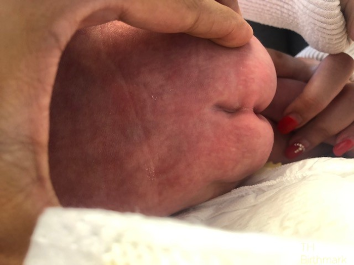 Patient 9: sacral dimple